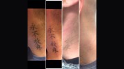 St James Tattoo Removal