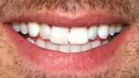 Teeth Whitening