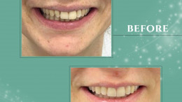 Invisalign Before & After 