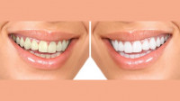 Zoom Whitening