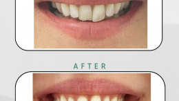 Invisalign Before & After 