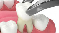 Tooth Extraction