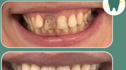 Invisalign Before & After 