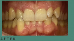 Invisalign Before & After 