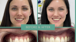 Invisalign Before & After 