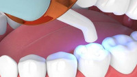 Fillings