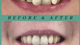 Invisalign Before & After 