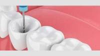 Root canal treatment