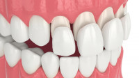 Dental Veneers